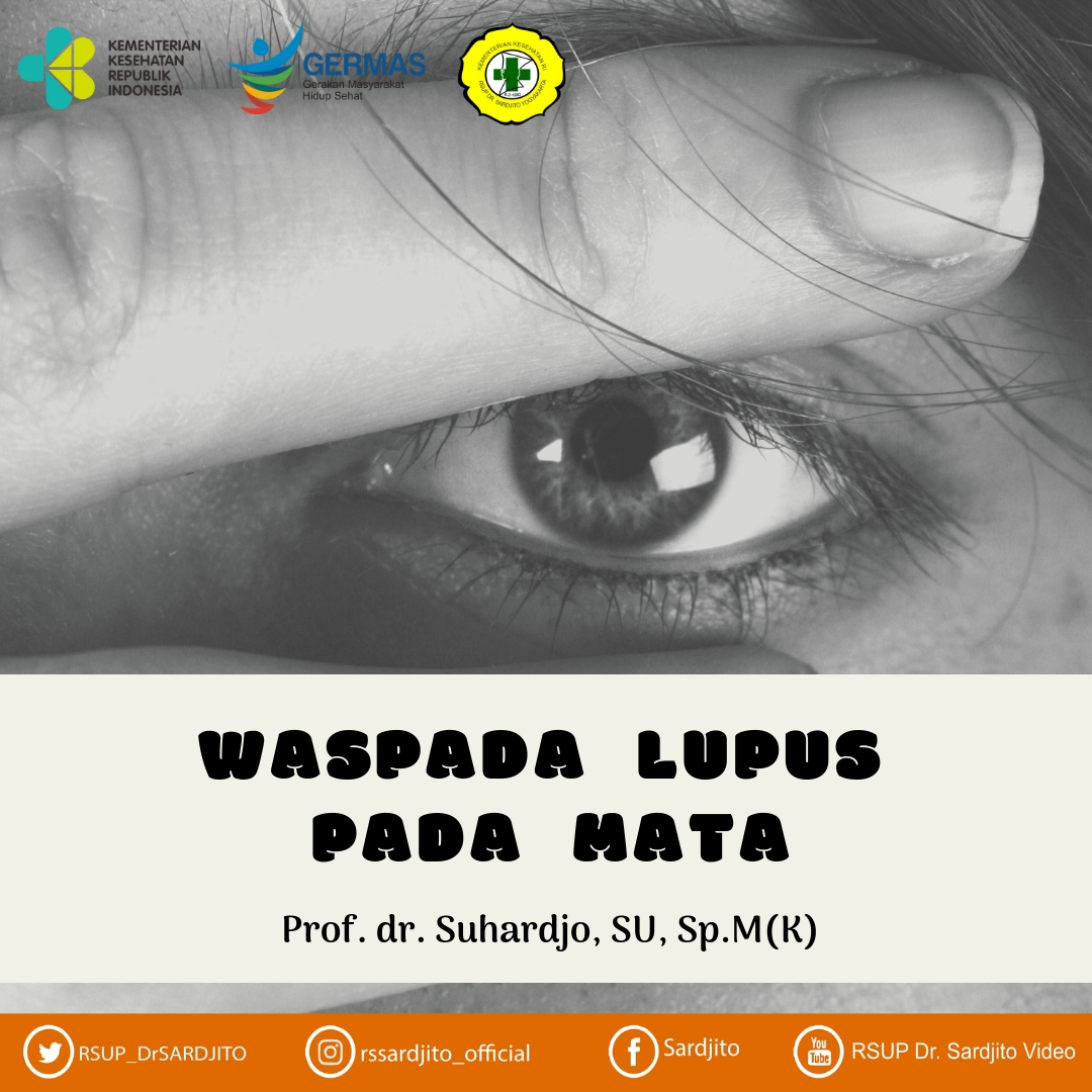 Waspada Lupus Pada Mata
