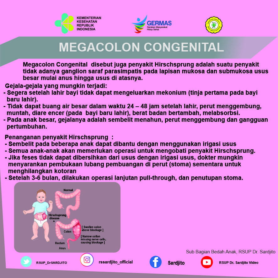 Megacolon Congenital