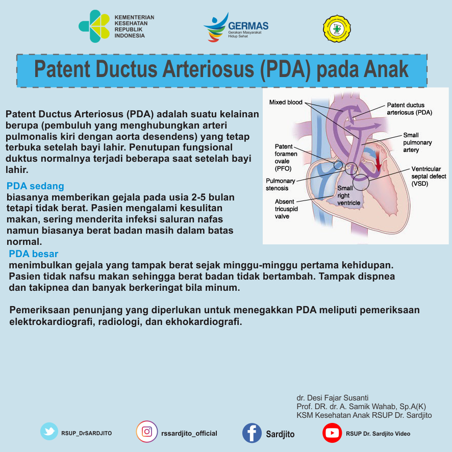 Patent Ductus Arteriosus (PDA) pada Anak