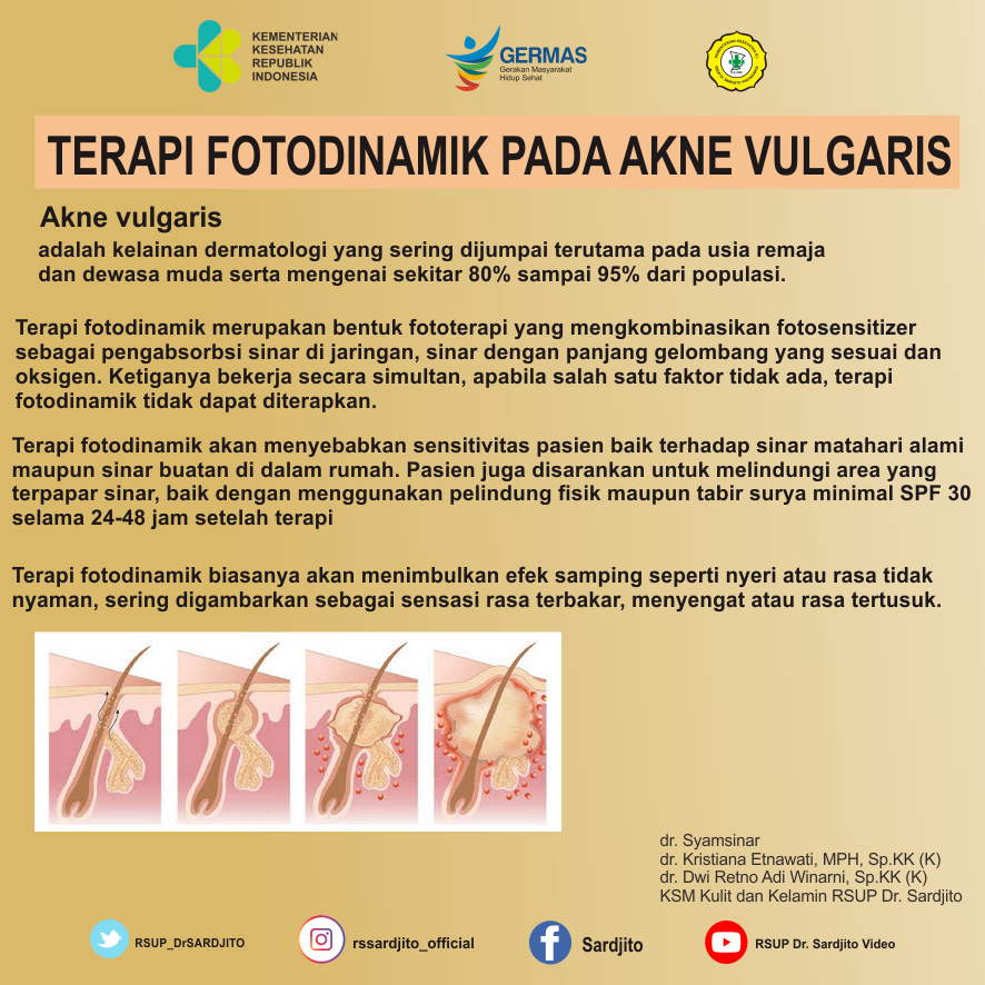 Terapi Fotodinamik Pada Akne Vulgaris