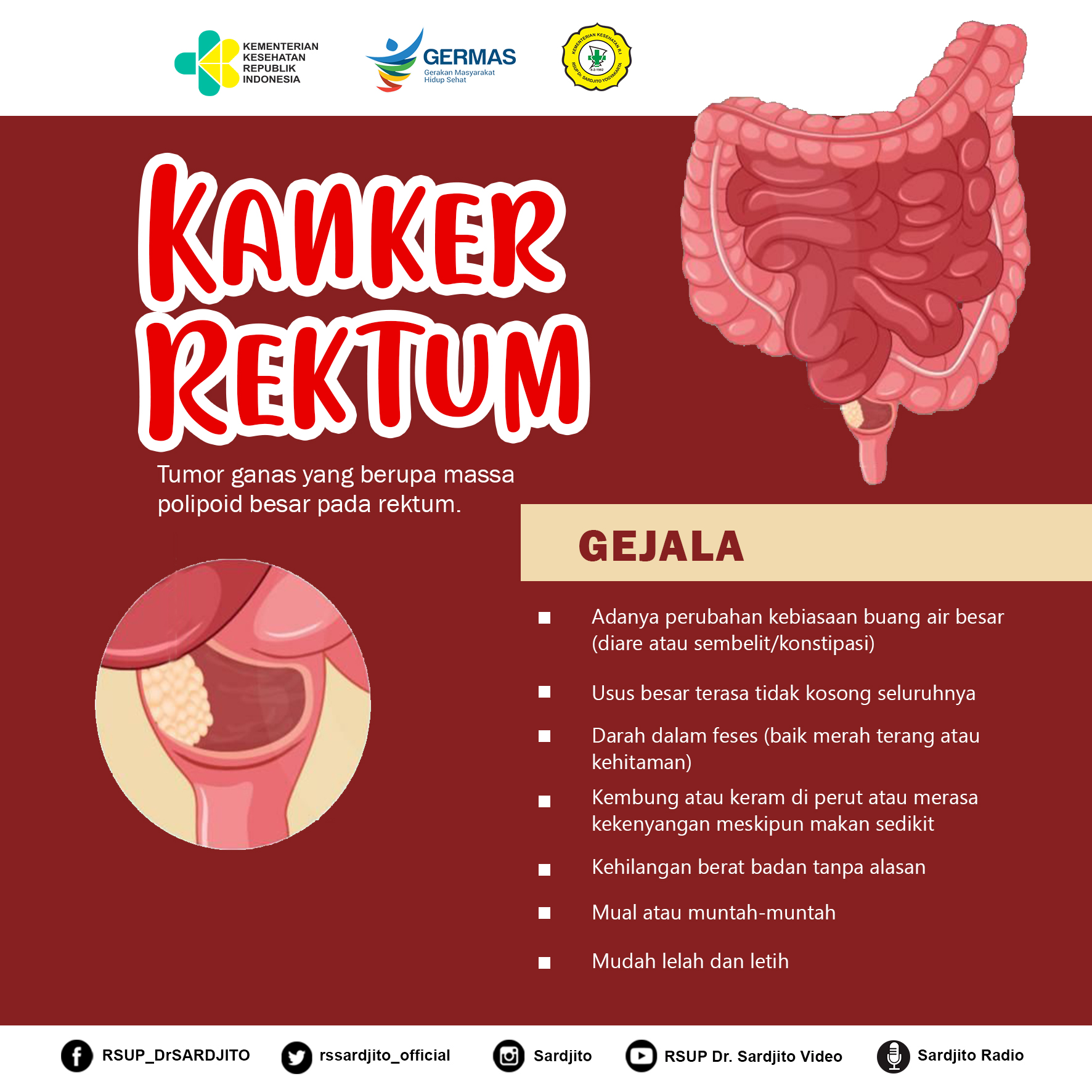 Waspadai Bahaya Kanker Rektum