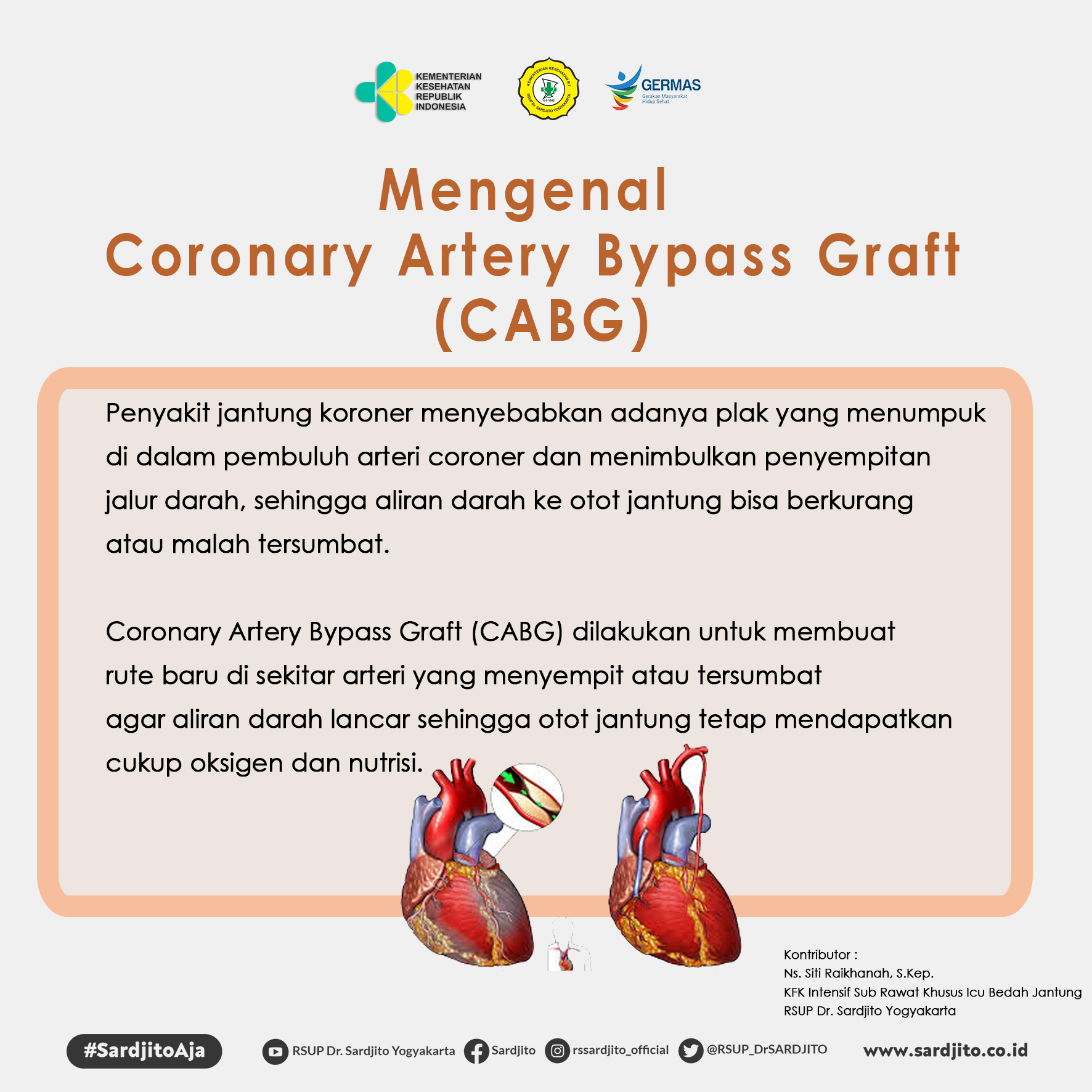 Mengenal Coronary Artery Bypass Graft (CABG)