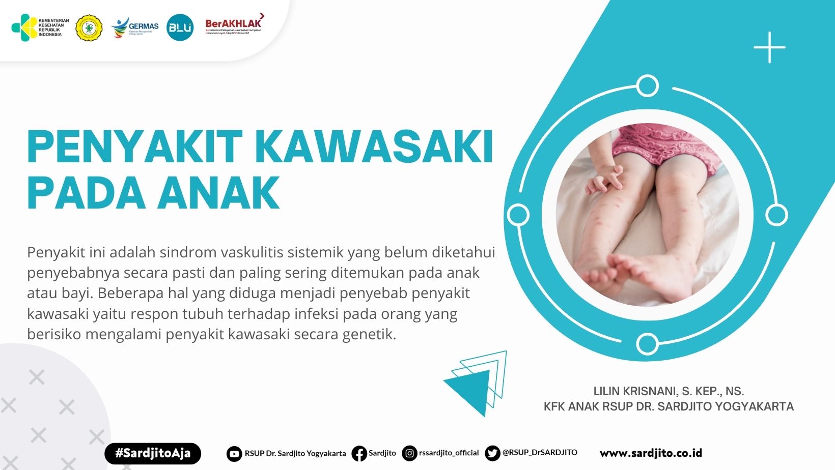 Penyakit Kawasaki Pada Anak